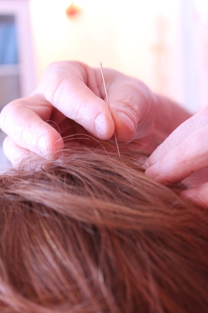 Acupuncture needles